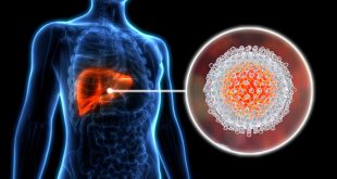 penyakit hepatitis A